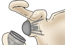 Intervenție în premieră în Gorj la Spitalul de Urgență Târgu Cărbunești