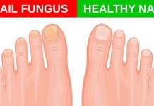 Ciuperca unghiei – Simptome şi tratament