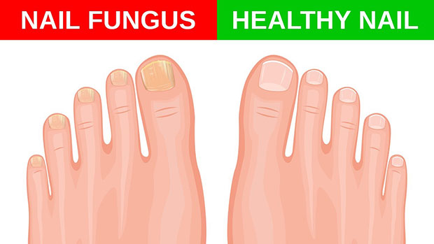 cum să vindeci ciuperca severă a unghiilor pulverizați ciuperca unghiilor