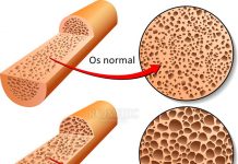 Ce trebuie să faci ca să previi osteoporoza