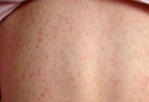 07:59 Scarlatină la un liceu din Târgu-Jiu