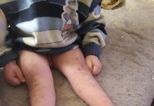 Acțiune umanitară un copil cu picioarele strâmbe. „Să le taie de aici să îmi pună altele să mă pot duce la grădiniță“