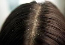 Scapă de mătreaţă cu remedii naturiste