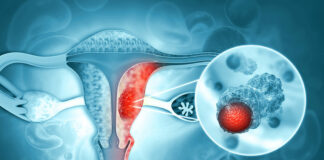 09:33 Peste 1000 de gorjence, diagnosticate cu cancer de col uterin. Recomandările medicilor
